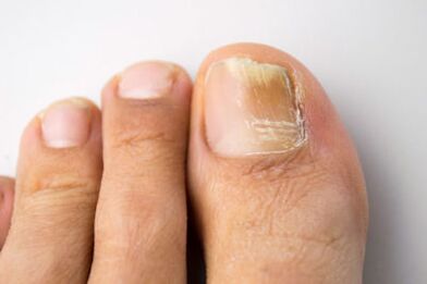 Mycosis způsobená kvasinkovými mikroorganismy